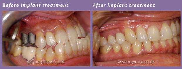 Implantology