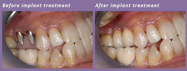 Implantology