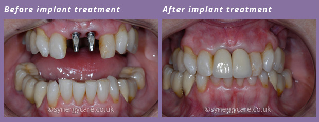 Implantology