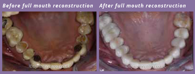 Prosthodontics