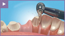 Dental Bridges