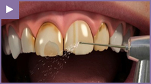 Porcelain Veneers